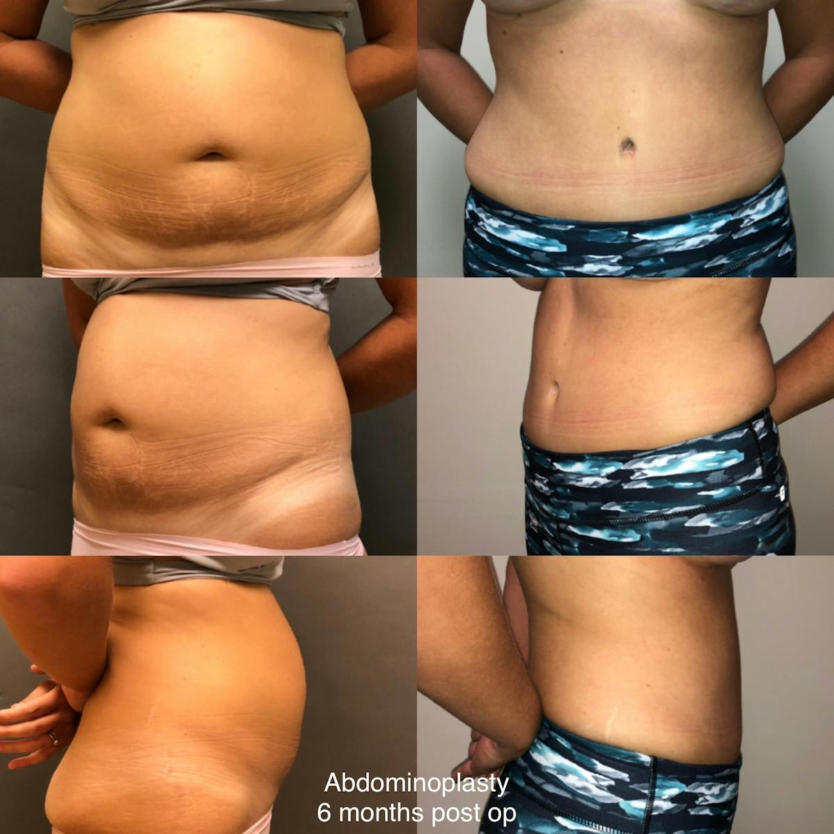 Abdominoplasty Before & After Gallery - Patient 355198 - Image 1