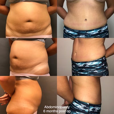 Abdominoplasty Before & After Gallery - Patient 355198 - Image 1