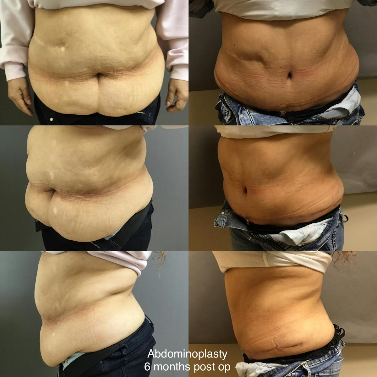 Abdominoplasty Before & After Gallery - Patient 318575 - Image 1