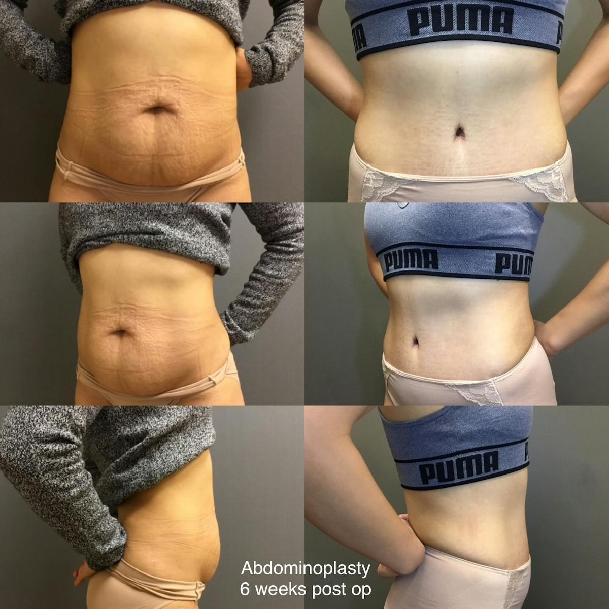 Abdominoplasty Before & After Gallery - Patient 670026 - Image 1
