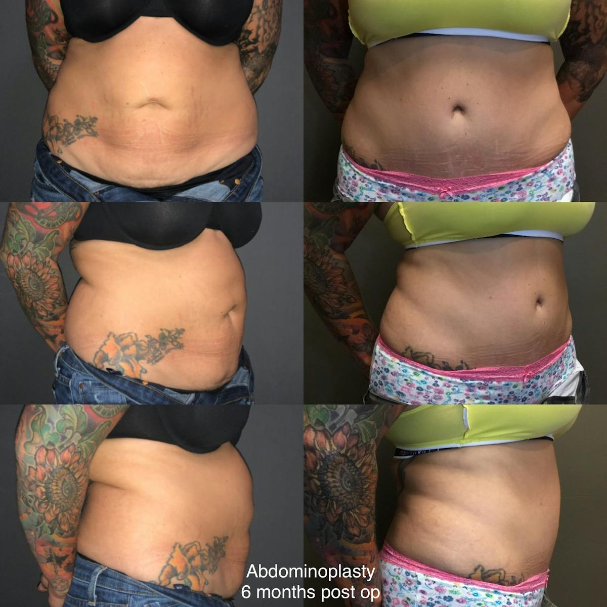 Abdominoplasty Before & After Gallery - Patient 164002 - Image 1