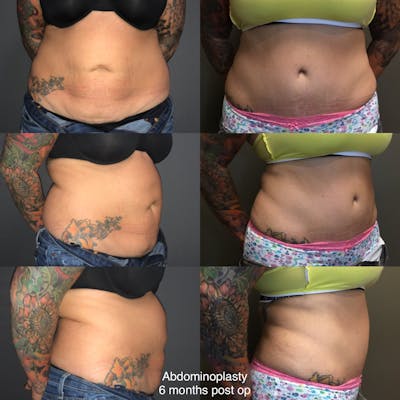 Abdominoplasty Before & After Gallery - Patient 164002 - Image 1