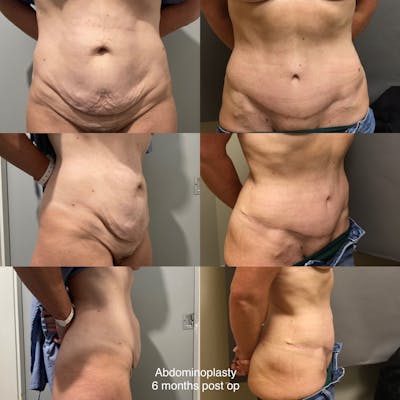 Abdominoplasty Before & After Gallery - Patient 185650 - Image 1