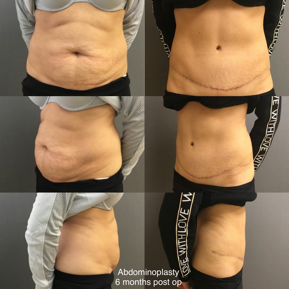 Abdominoplasty Before & After Gallery - Patient 371958 - Image 1