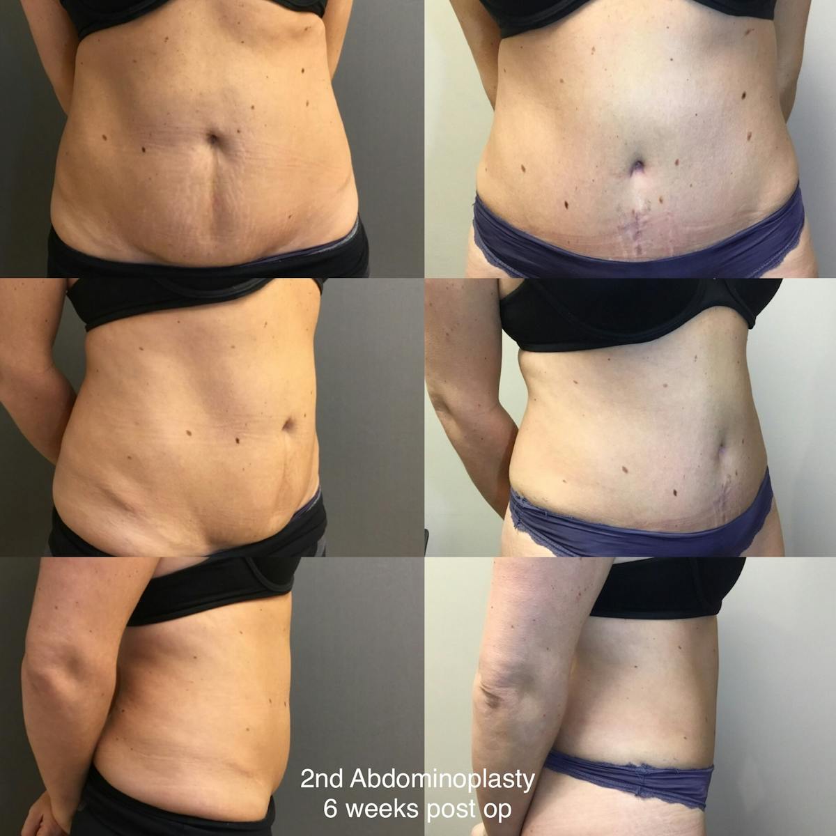 Abdominoplasty Before & After Gallery - Patient 966346 - Image 1