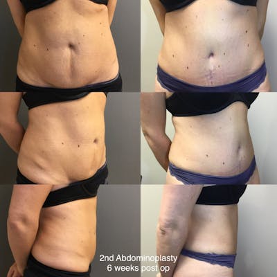 Abdominoplasty Before & After Gallery - Patient 966346 - Image 1