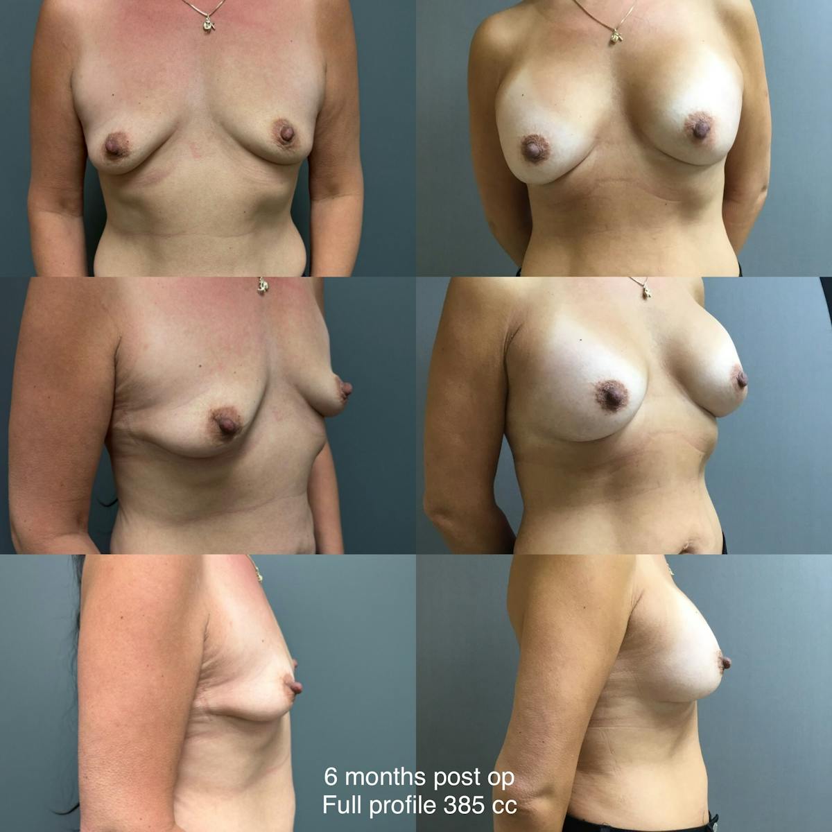 BBA Before & After Gallery - Patient 428024 - Image 1