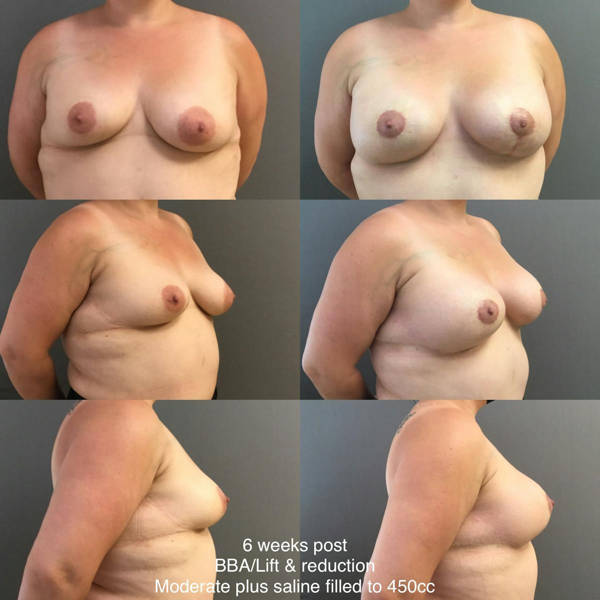 BBA-Lift Before & After Gallery - Patient 329191 - Image 1