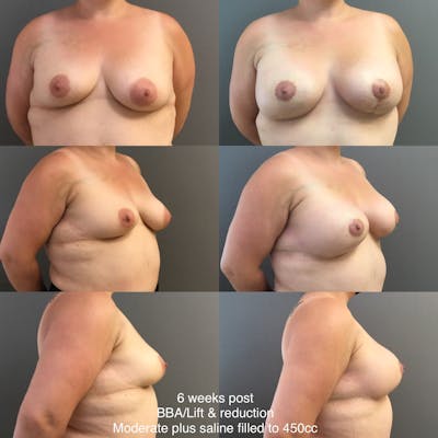 BBA-Lift Before & After Gallery - Patient 329191 - Image 1