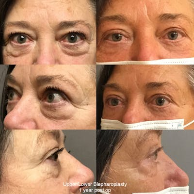 Blepharoplasty Before & After Gallery - Patient 404554 - Image 1