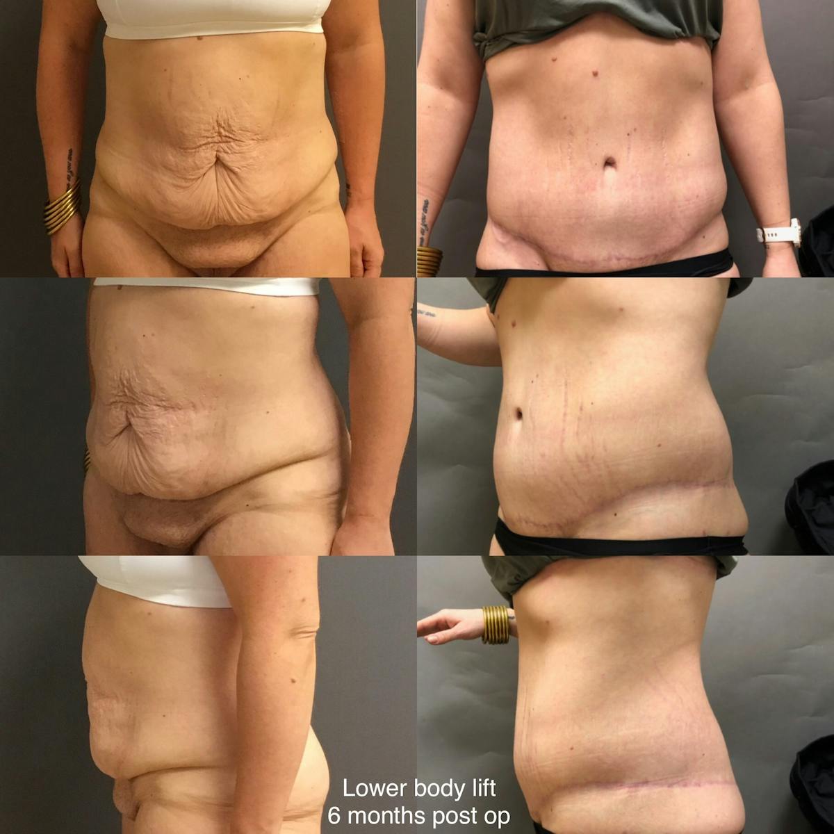 Body Lift Before & After Gallery - Patient 232533 - Image 1