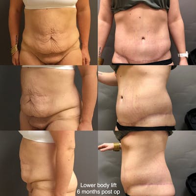 Body Lift Before & After Gallery - Patient 232533 - Image 1