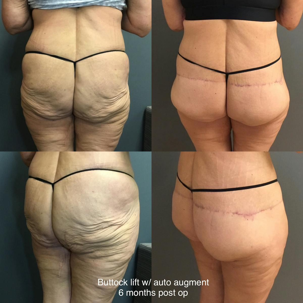 Body Lift Before & After Gallery - Patient 355417 - Image 1