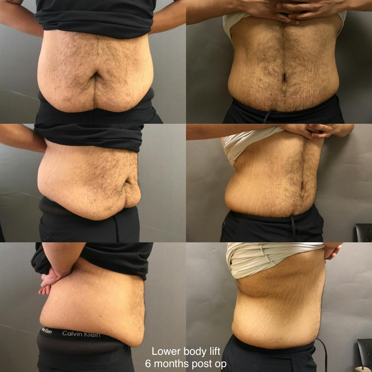 Body Lift Before & After Gallery - Patient 148504 - Image 1