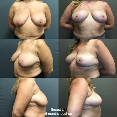 Breast Lift-Reduction Before & After Gallery - Patient 735653 - Image 1