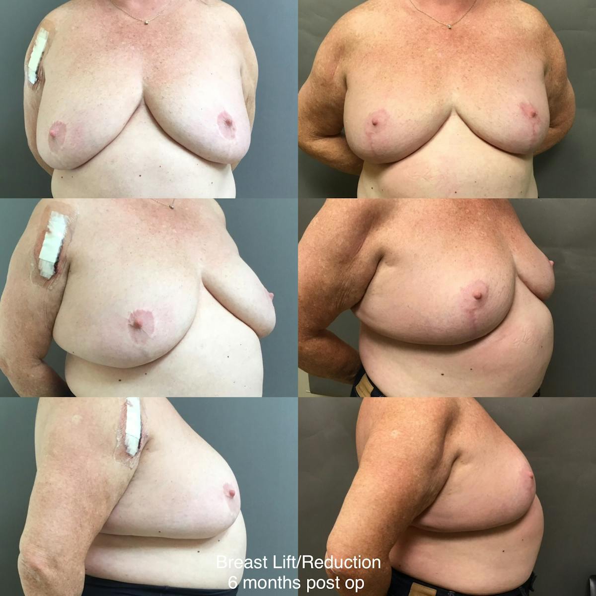 Breast Lift-Reduction Before & After Gallery - Patient 187198 - Image 1