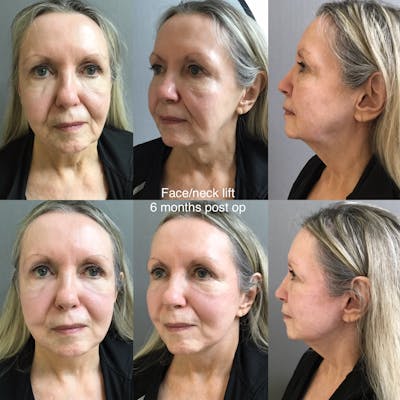 Face-Neck Lift Before & After Gallery - Patient 143998 - Image 1