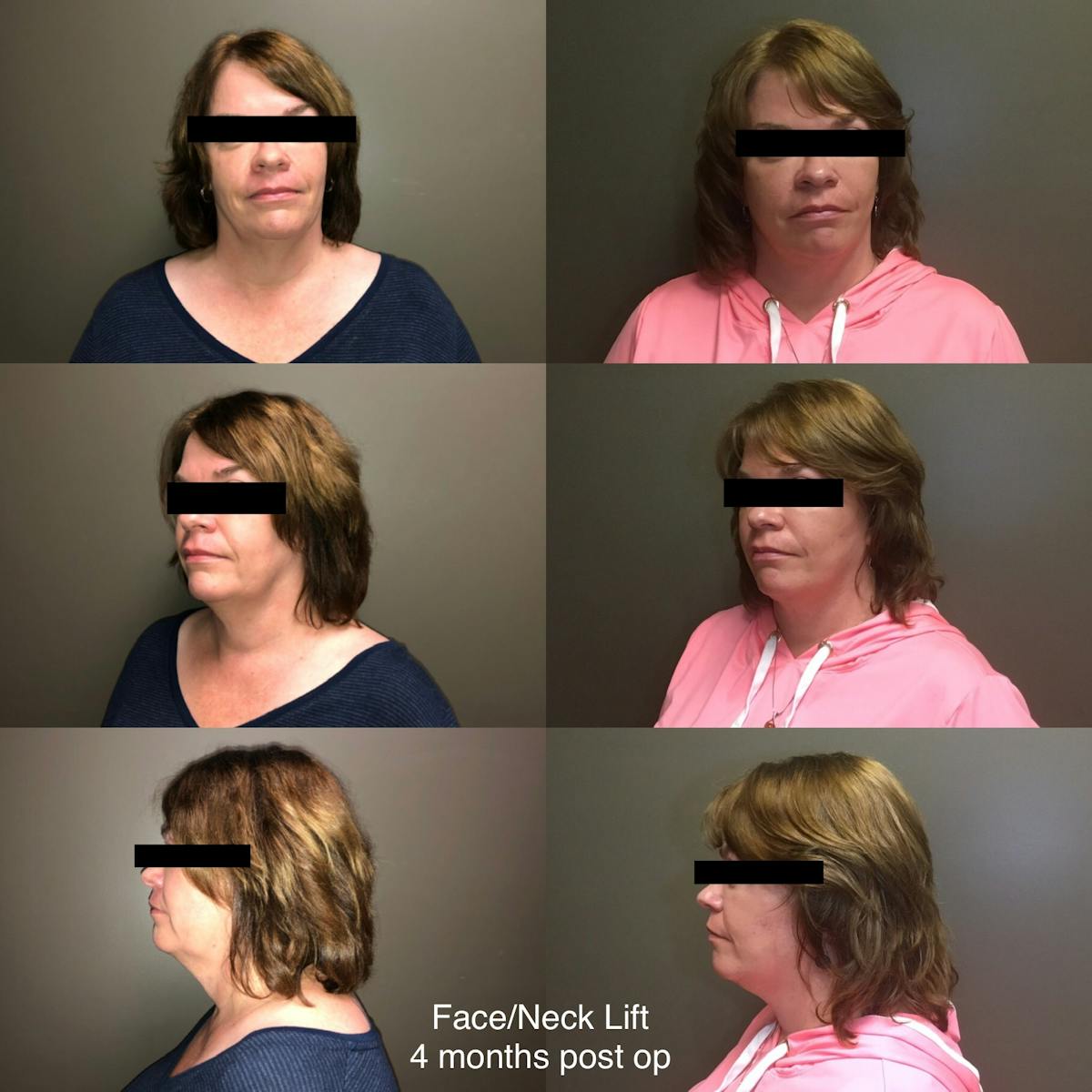 Face-Neck Lift Before & After Gallery - Patient 113003 - Image 1