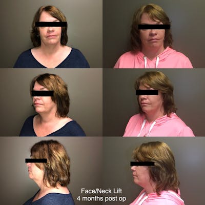 Face-Neck Lift Before & After Gallery - Patient 113003 - Image 1