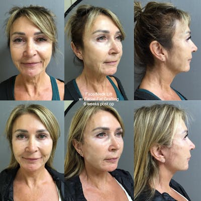 Face-Neck Lift Before & After Gallery - Patient 126094 - Image 1