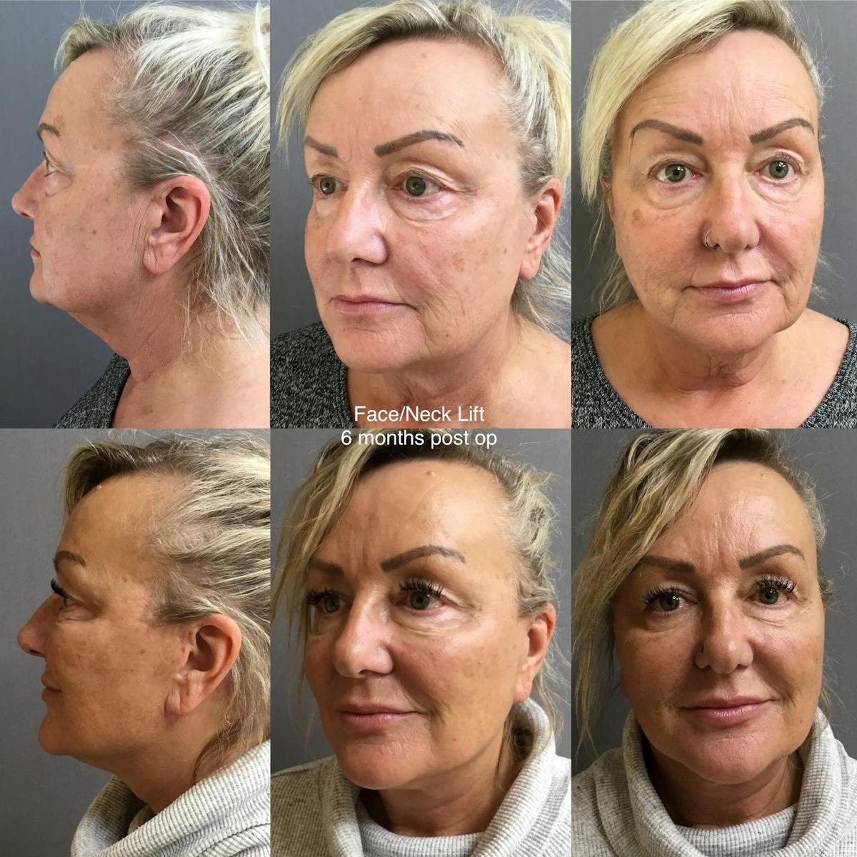 Face-Neck Lift Before & After Gallery - Patient 364148 - Image 1