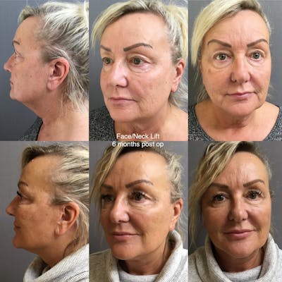 Face-Neck Lift Before & After Gallery - Patient 364148 - Image 1