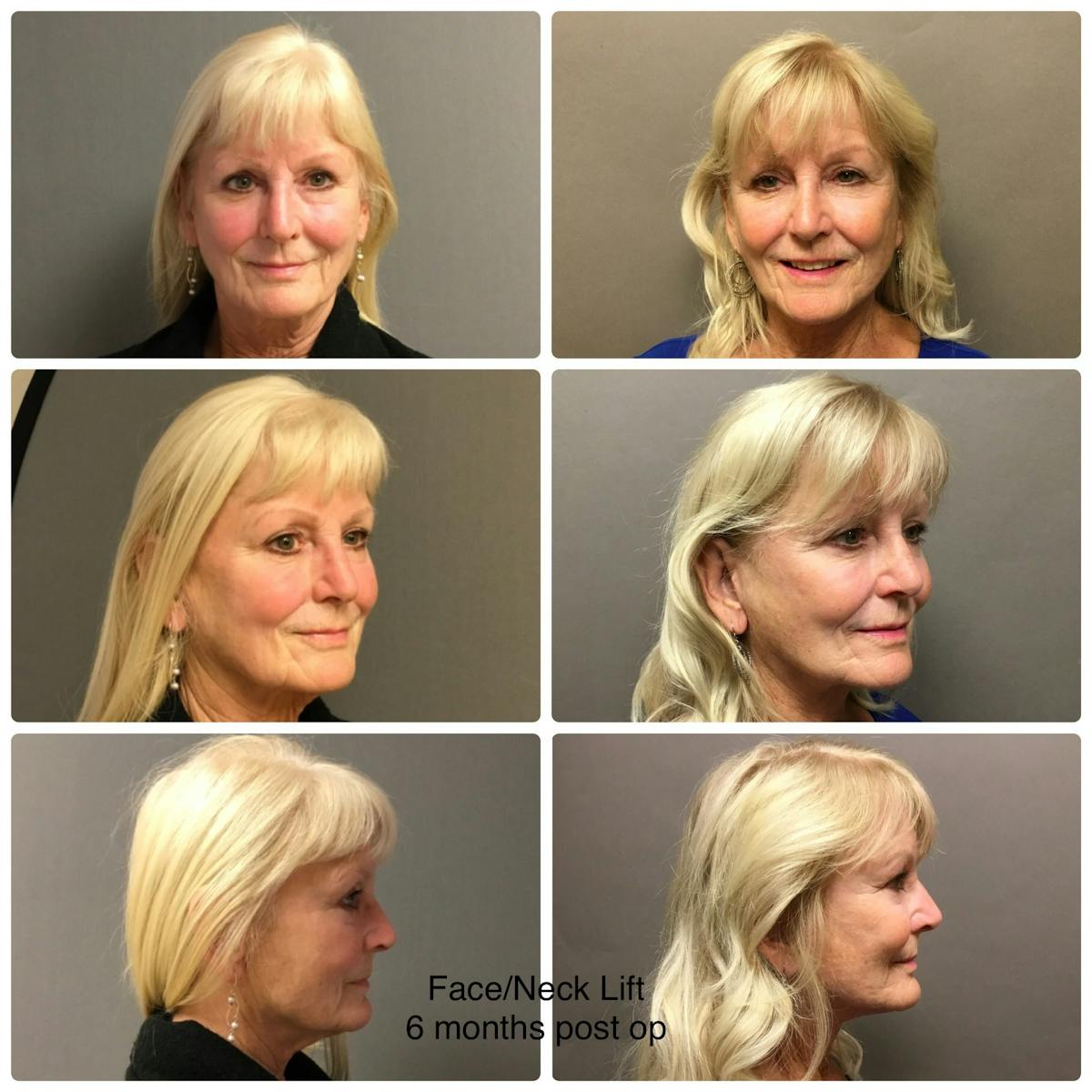 Face-Neck Lift Before & After Gallery - Patient 152737 - Image 1