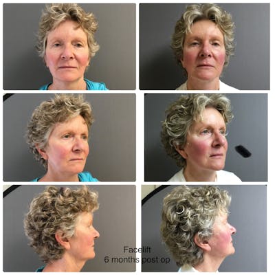 Face-Neck Lift Before & After Gallery - Patient 460009 - Image 1