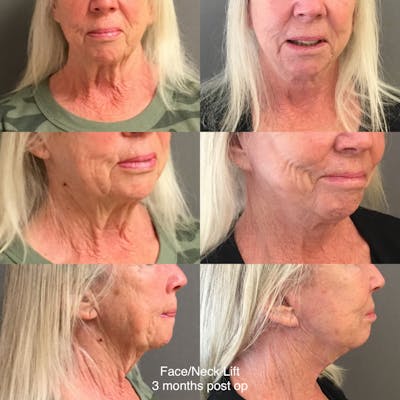 Face-Neck Lift Before & After Gallery - Patient 191738 - Image 1