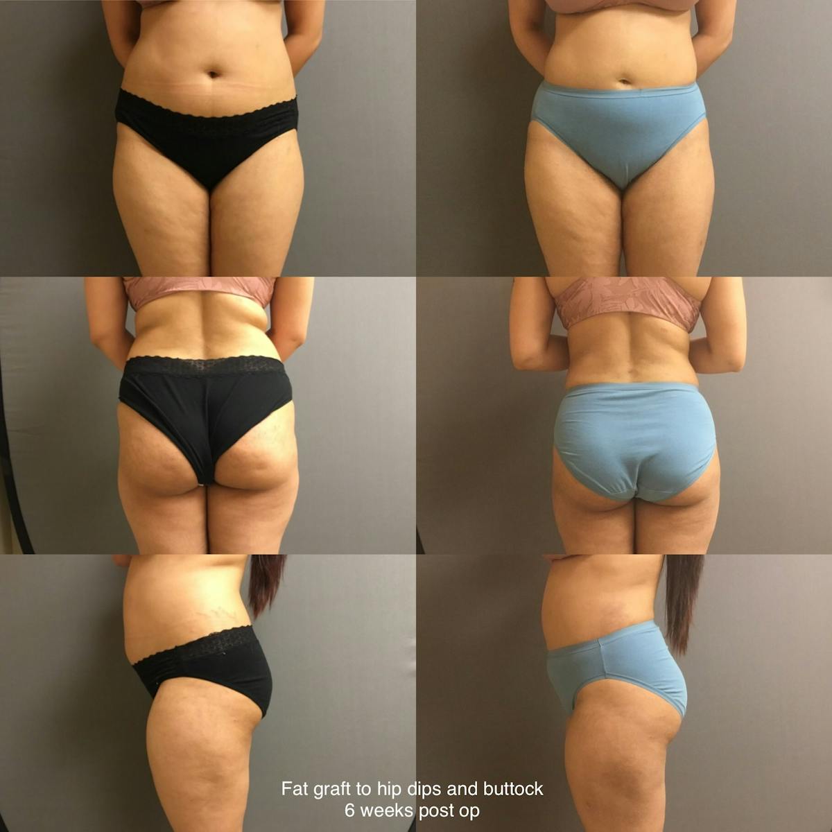 Fat Grafting Before & After Gallery - Patient 189631 - Image 1