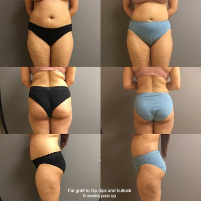 Fat Grafting Before & After Gallery - Patient 189631 - Image 1