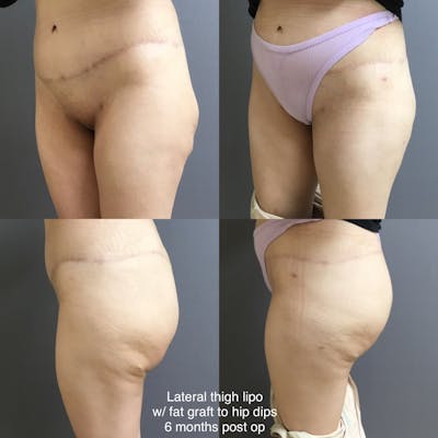 Fat Grafting Before & After Gallery - Patient 686282 - Image 1