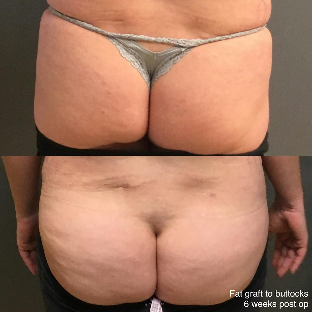 Fat Grafting Before & After Gallery - Patient 259300 - Image 1