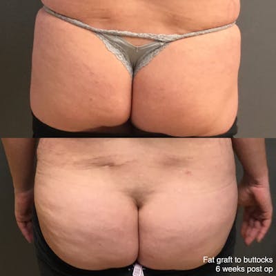 Fat Grafting Before & After Gallery - Patient 259300 - Image 1
