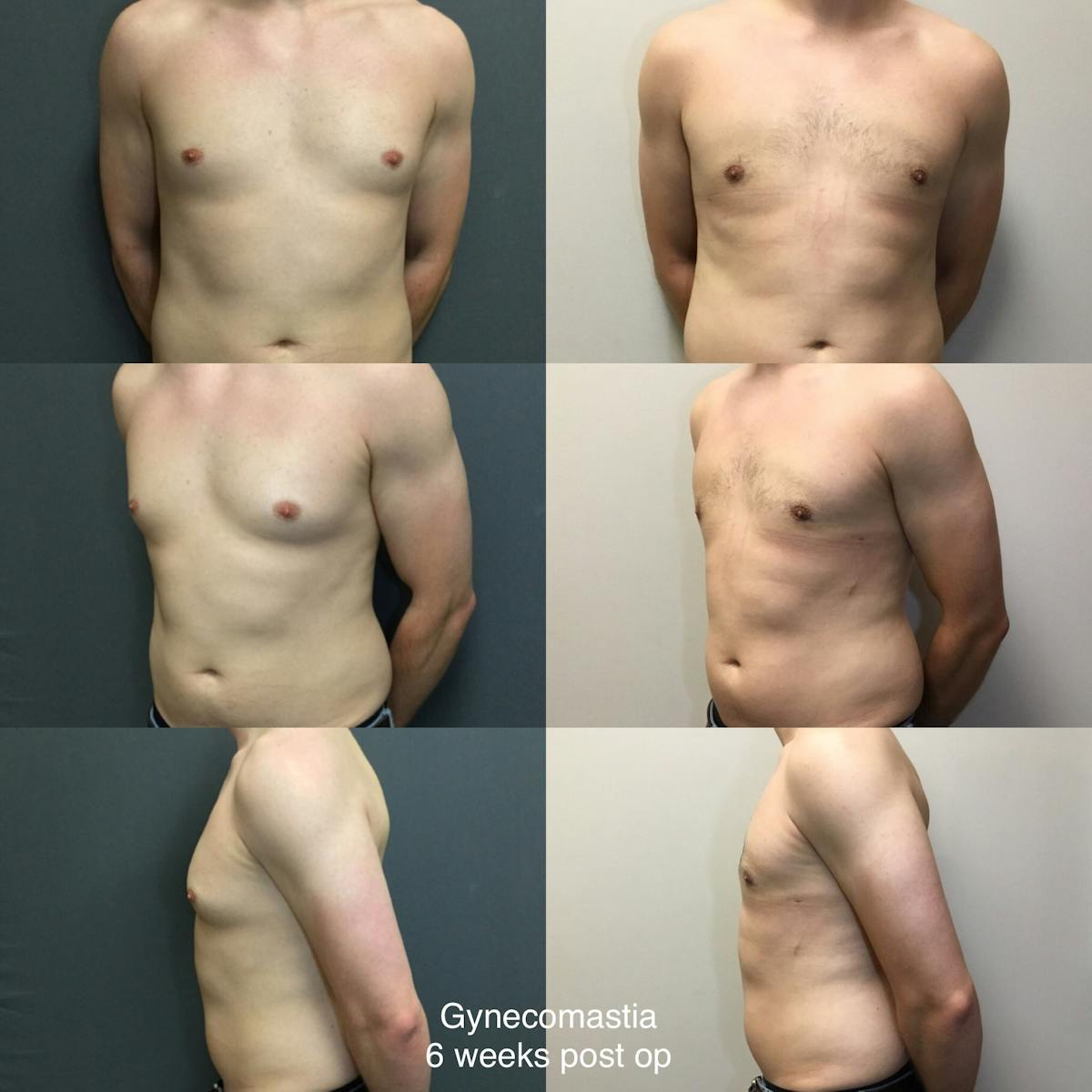 Gynecomastia Before & After Gallery - Patient 205916 - Image 1