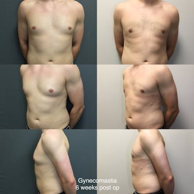 Gynecomastia Before & After Gallery - Patient 205916 - Image 1