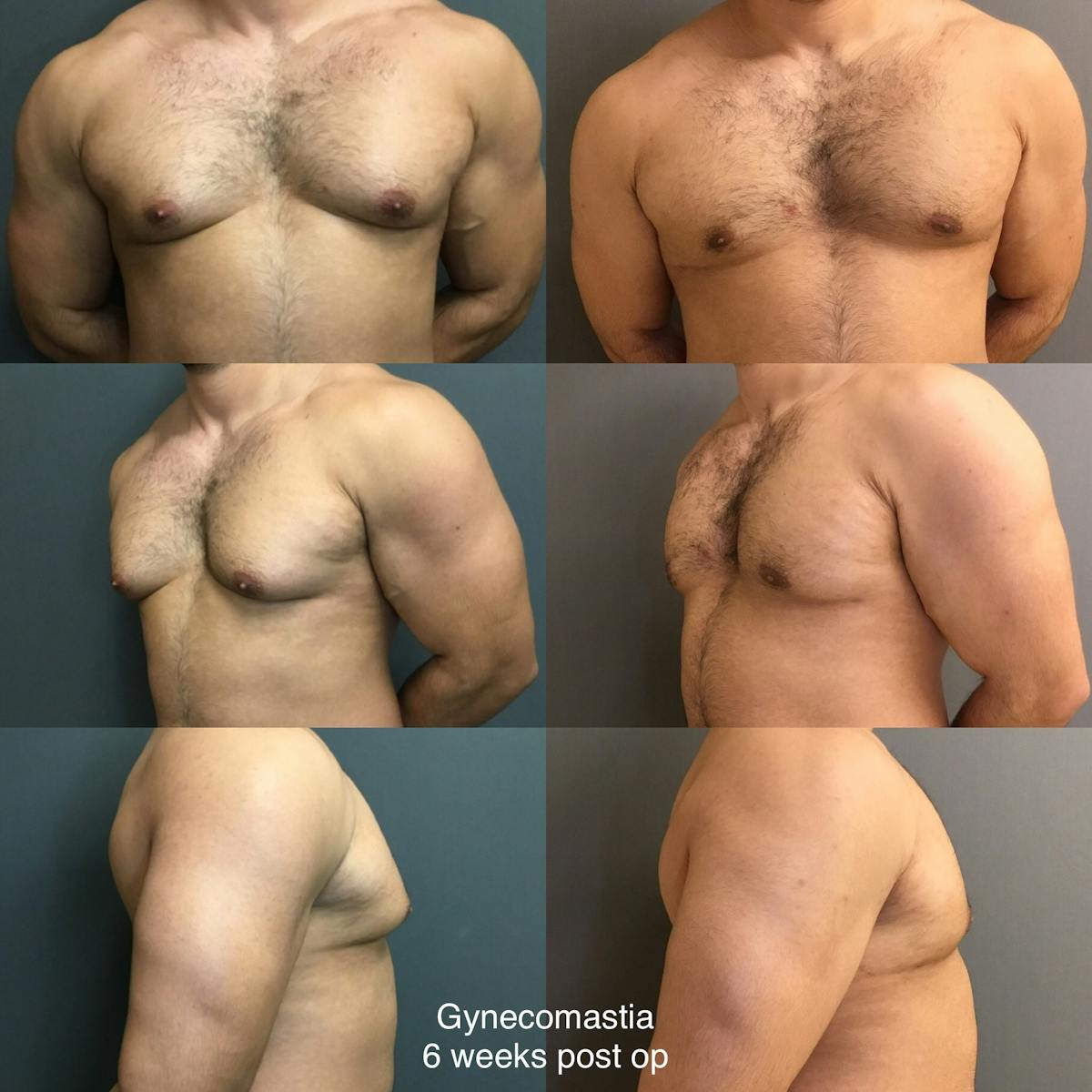 Gynecomastia Before & After Gallery - Patient 125771 - Image 1