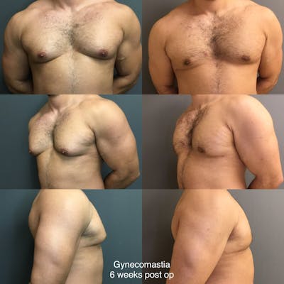 Gynecomastia Before & After Gallery - Patient 125771 - Image 1