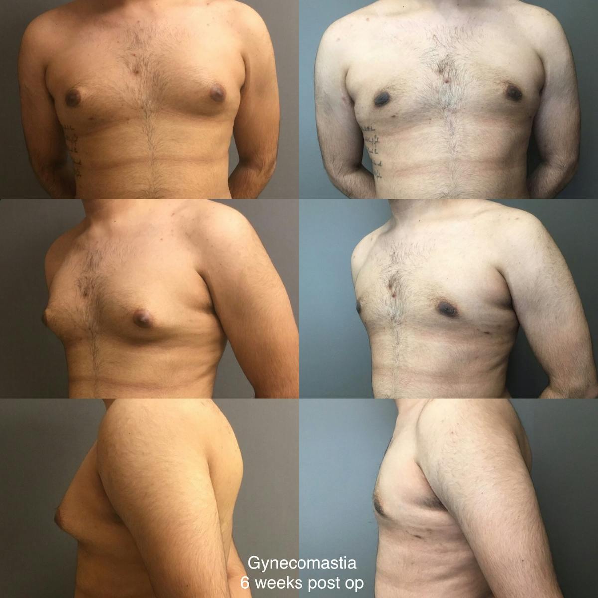 Gynecomastia Before & After Gallery - Patient 320629 - Image 1