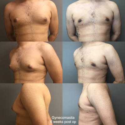 Gynecomastia Before & After Gallery - Patient 320629 - Image 1