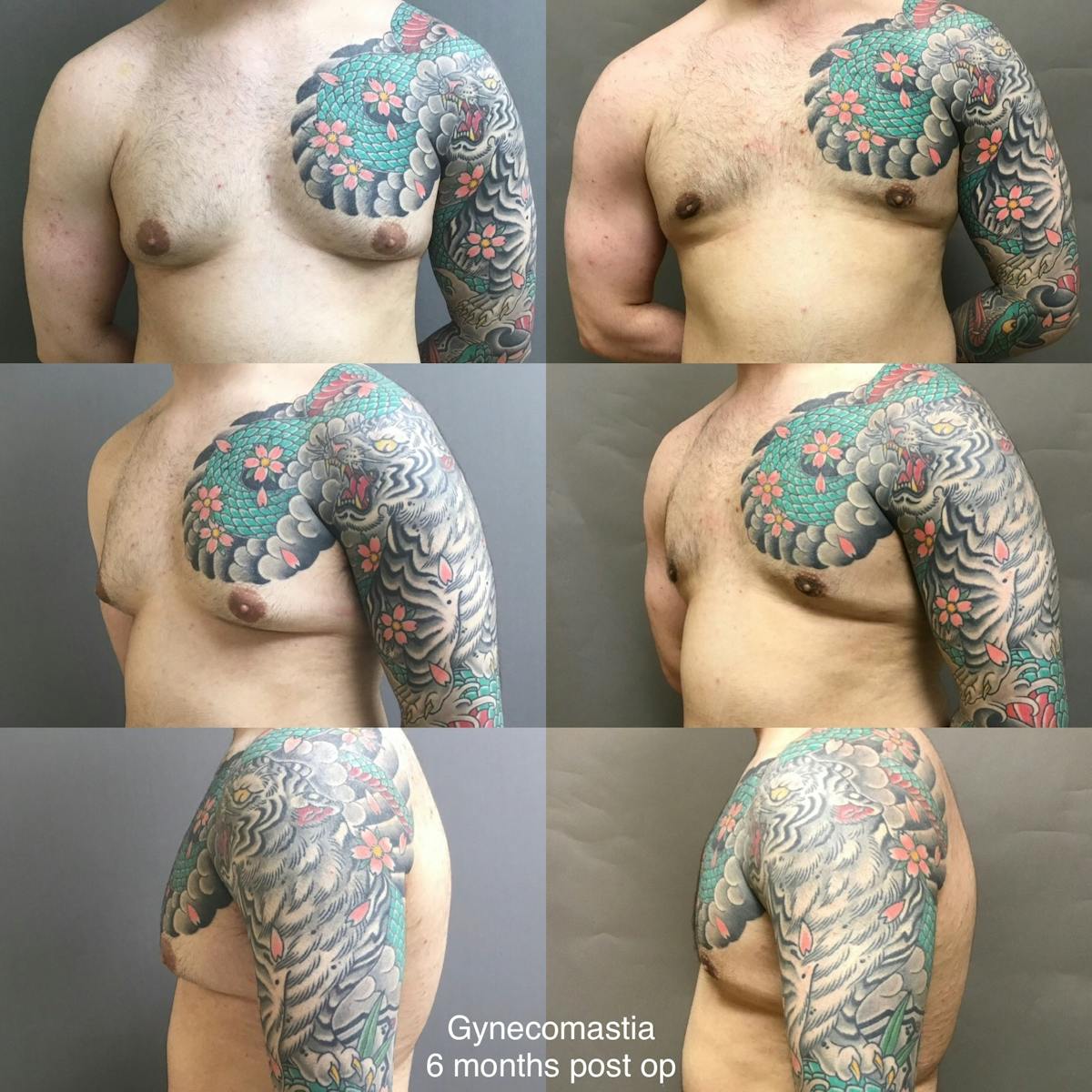 Gynecomastia Before & After Gallery - Patient 137539 - Image 1