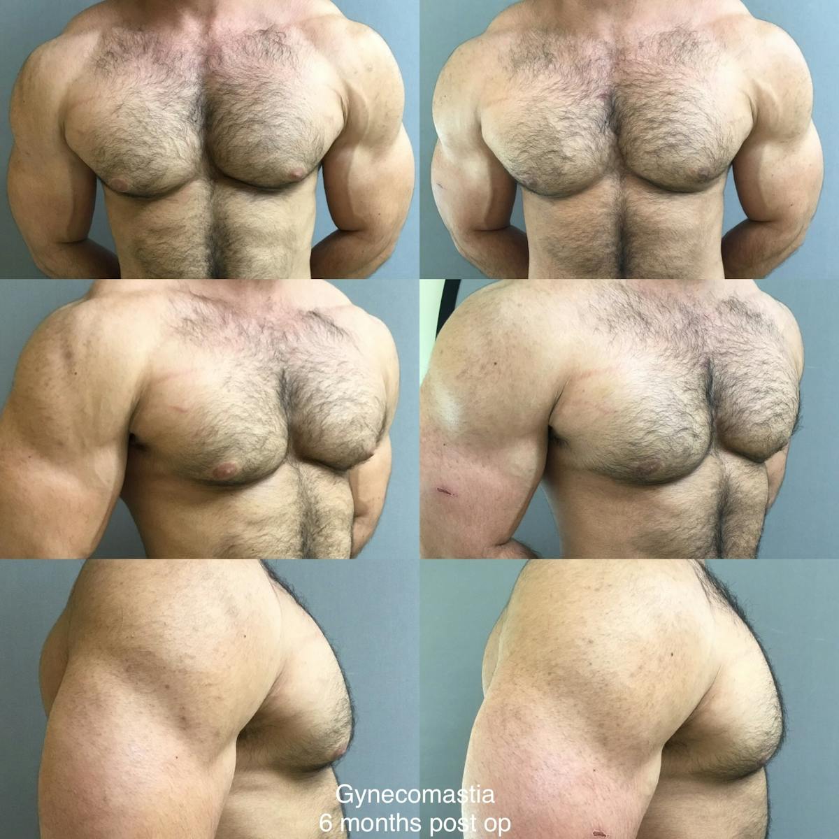 Gynecomastia Before & After Gallery - Patient 344727 - Image 1