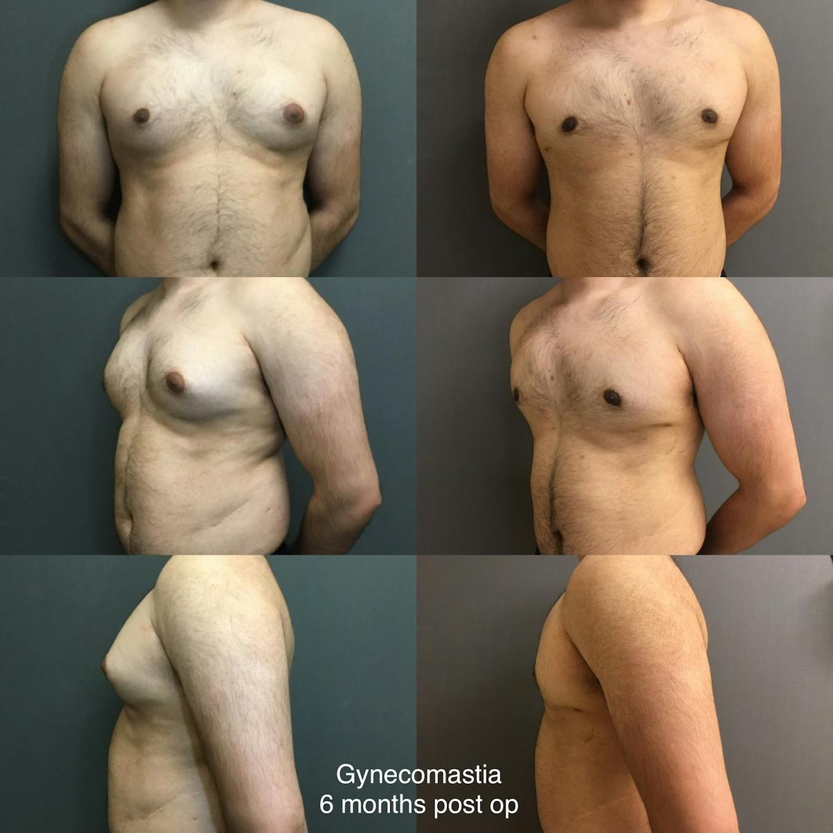 Gynecomastia Before & After Gallery - Patient 259237 - Image 1