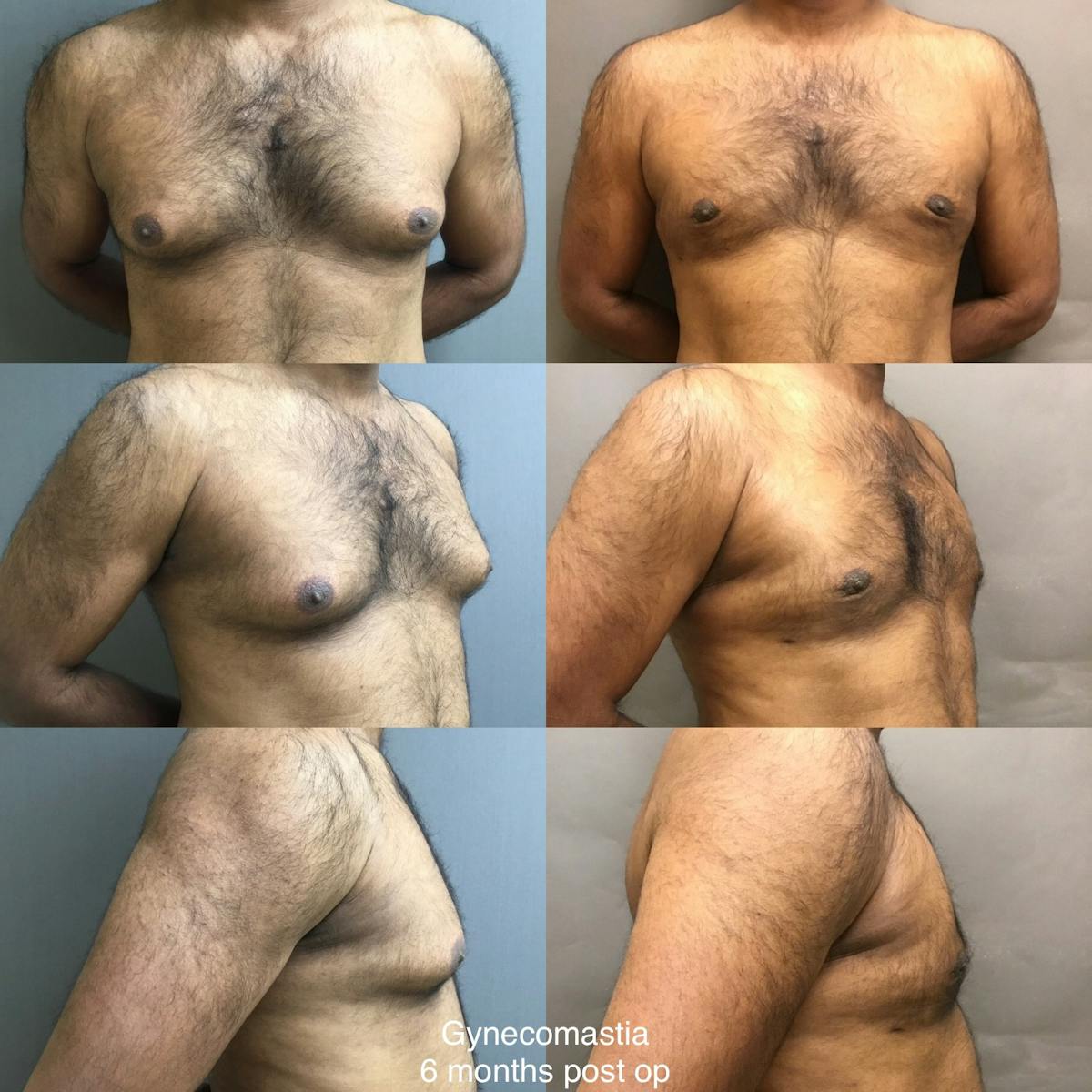 Gynecomastia Before & After Gallery - Patient 328468 - Image 1