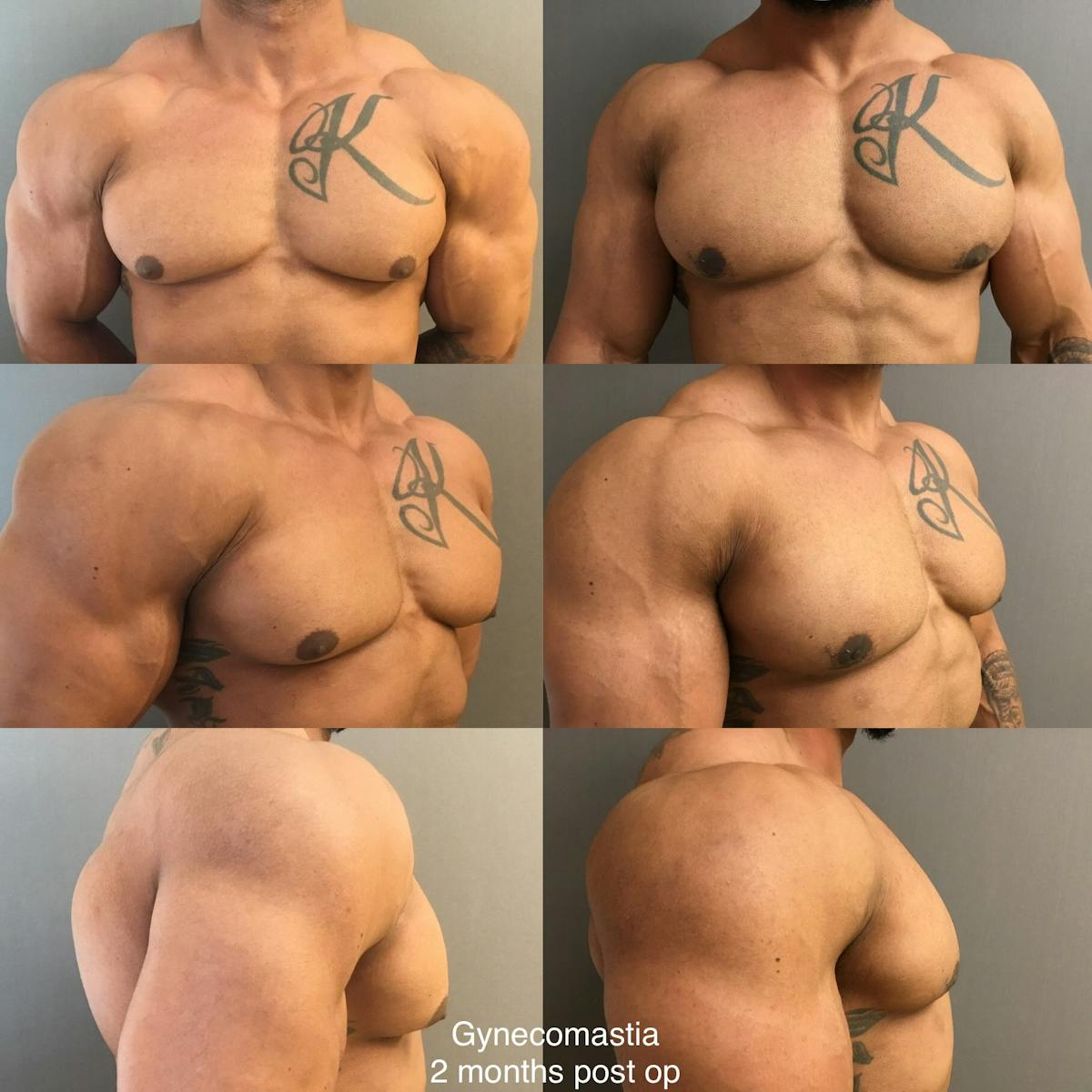 Gynecomastia Before & After Gallery - Patient 289823 - Image 1