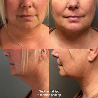 Liposuction Before & After Gallery - Patient 164461 - Image 1