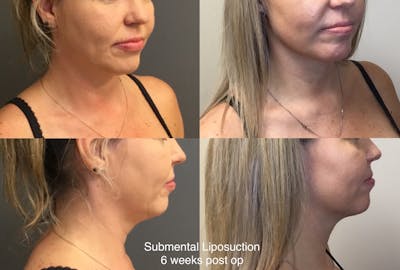 Liposuction Before & After Gallery - Patient 963802 - Image 1