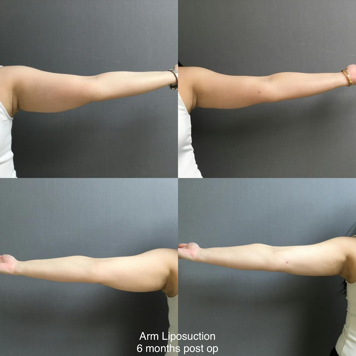Liposuction Before & After Gallery - Patient 408951 - Image 1
