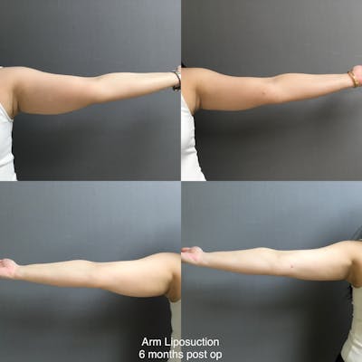Liposuction Before & After Gallery - Patient 408951 - Image 1