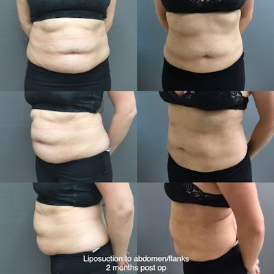 Liposuction Before & After Gallery - Patient 378185 - Image 1